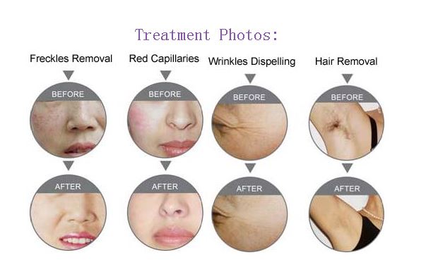 E-light Ipl Rf+nd Yag Laser Multifunction Machine E-light Ipl Rf+nd Yag Laser Multifunction Machine