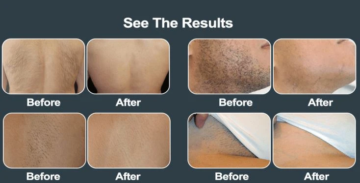 medical laser hiar removal medical laser hiar removal